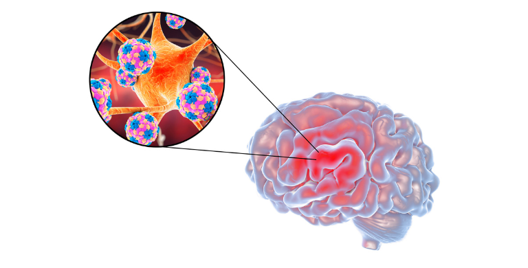 Meningitis: Causes, symptoms, treatment, and prevention